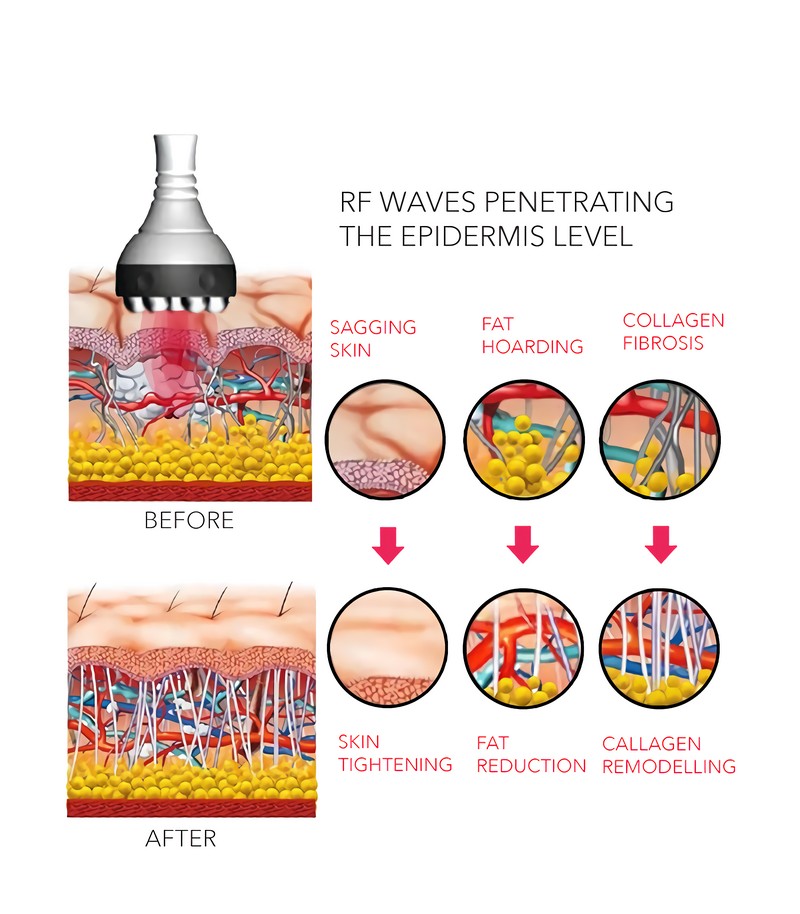 rf body contouring what you need to know 2