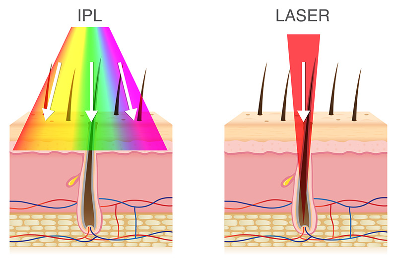 which is better for hair removal diode laser or ipl 2